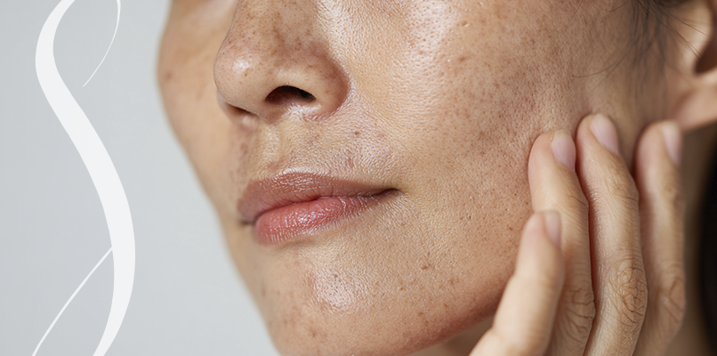 silvia-yabar-melasma