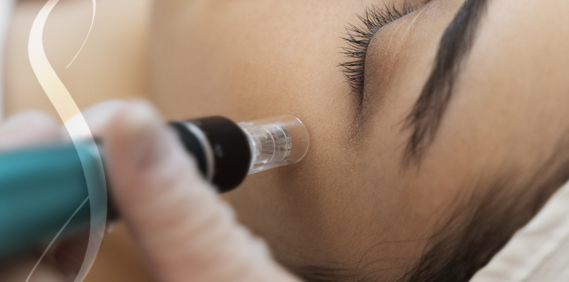 silvia-yabar-microagulhamento-facial